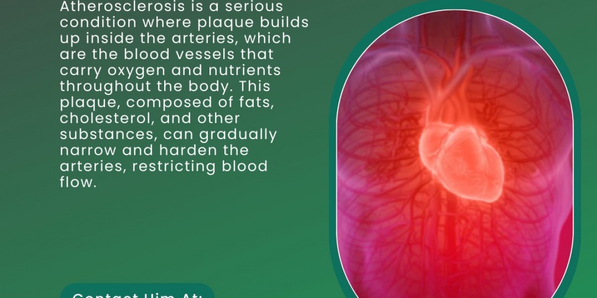 Understanding Atherosclerosis: Causes, Risks, and Management