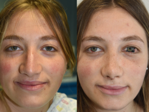 Trovare il miglior chirurgo per la rinoplastica: competenza, precisione e riconoscimento globale – La rinoplastica in Ospedale